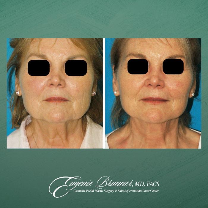 Eugenie Brunner, MD, FACS - Princeton, NJ