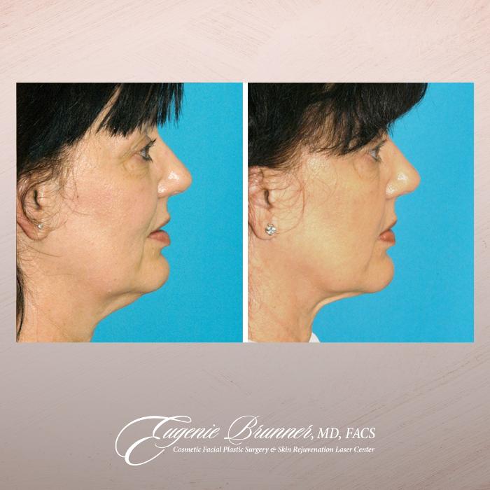 Eugenie Brunner, MD, FACS - Princeton, NJ