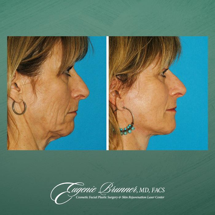 Eugenie Brunner, MD, FACS - Princeton, NJ