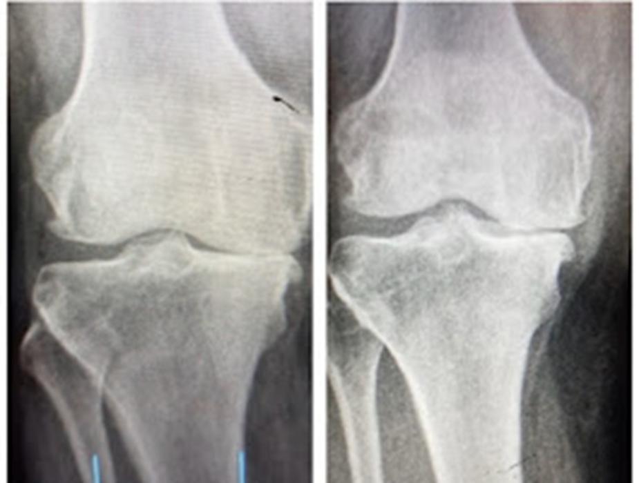 Our non-surgical, non-narcotic pain relief treatments utilize your body's natural ability to heal and help alleviate and cease symptoms associated with chronic pain.