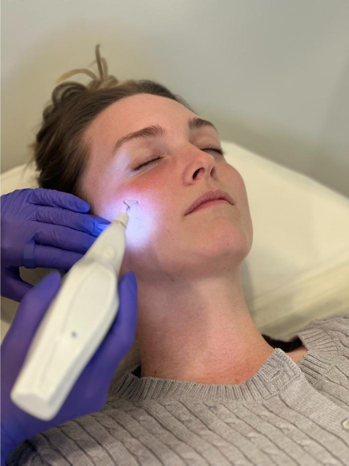 Plasma Resurfacing for fine lines, wrinkles, and lifts!