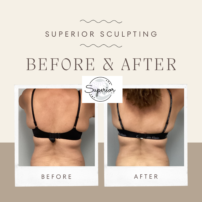 Superior Sculpting - Vero Beach, FL