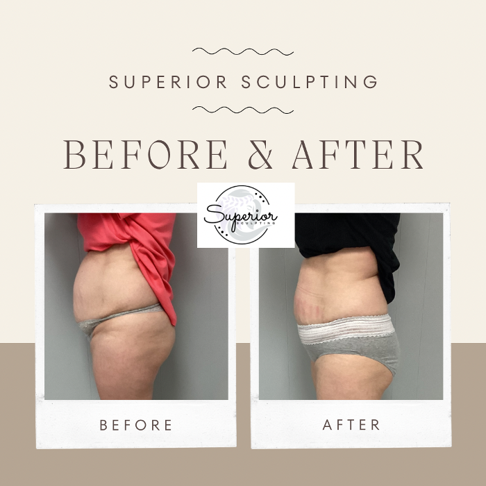 Superior Sculpting - Vero Beach, FL