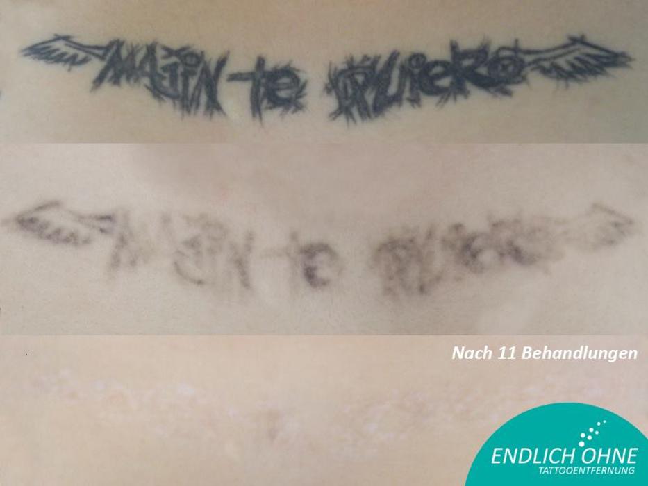 ENDLICH OHNE Tattooentfernung Filiale Endingen/Freiburg, Lehenhofstraße in Endingen am Kaiserstuhl