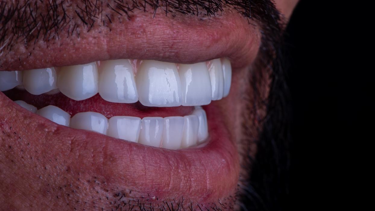 Next Smile + Implant