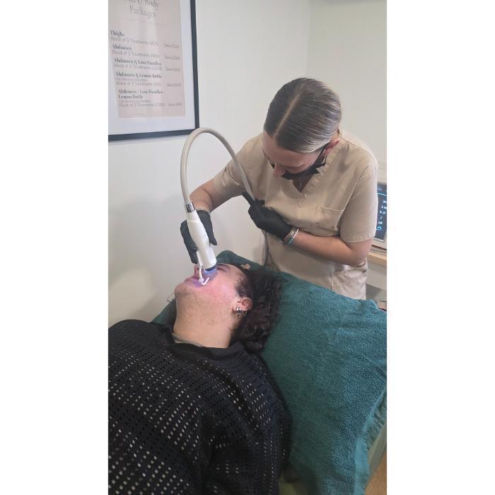 RF Fractional Micro-Needling Treatment
