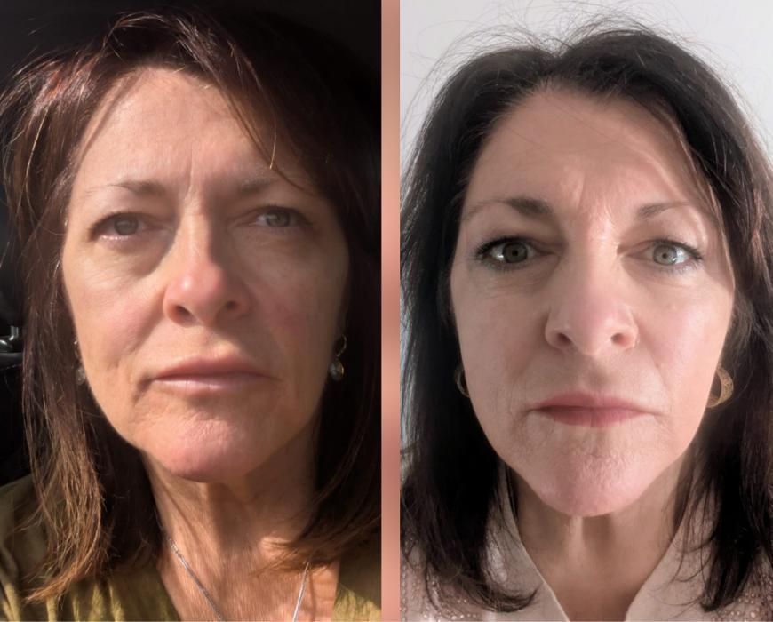 8 point face lift treatment before and after photo