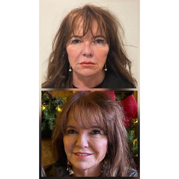 8 point face lift treatment before and after photo