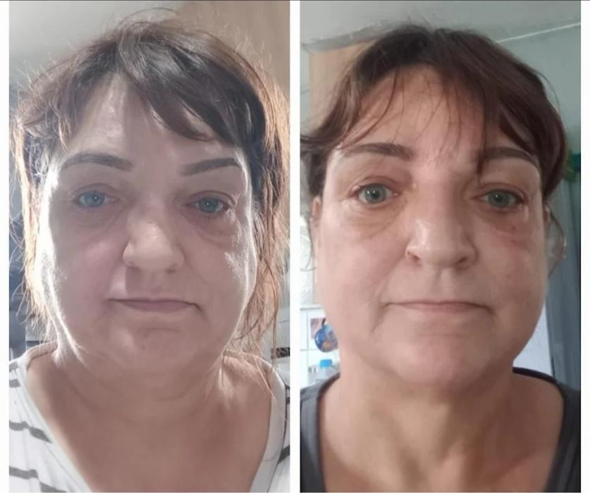 HIFU Full Face & Neck Lift Treatment before and after photo