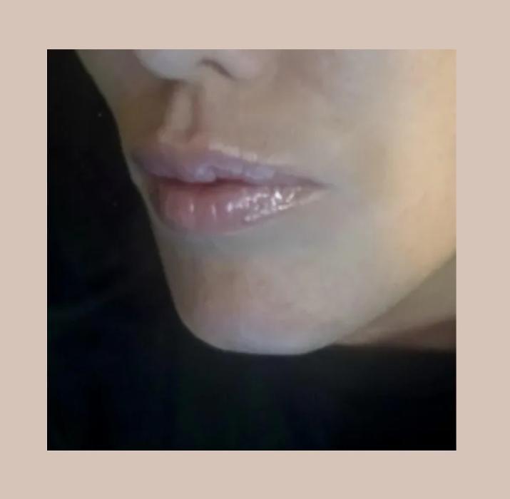 Lip Filler Treatment