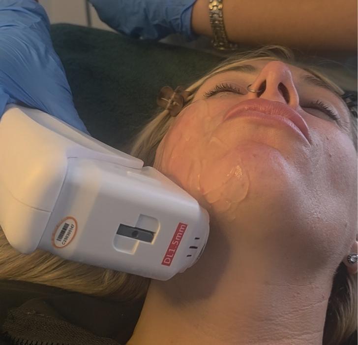 HIFU Neck & Jowl Lift