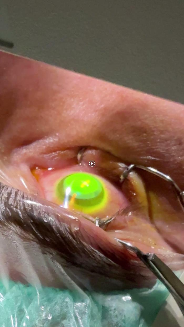 EyeLaser Zürich | Augenlasern & Linsenchirurgie, Strehlgasse in Zürich