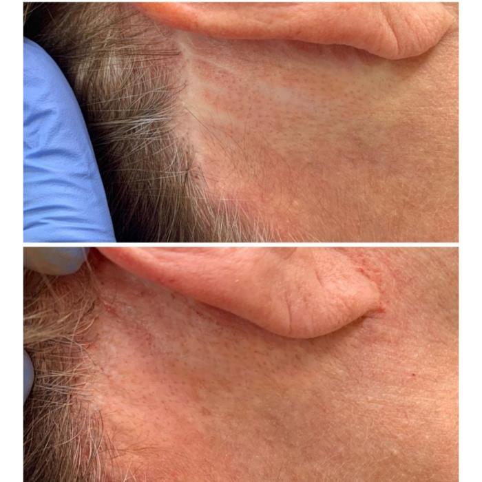 Advanced scar camouflage tattooing at The De Peyer Clinic designed to improve skin tone uniformity in a safe clinical environment.