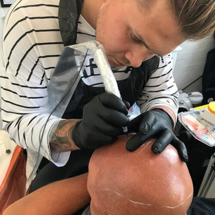 Professional scalp medical tattooing at The De Peyer Clinic in Durley, Southampton, creating the appearance of fuller hair density.