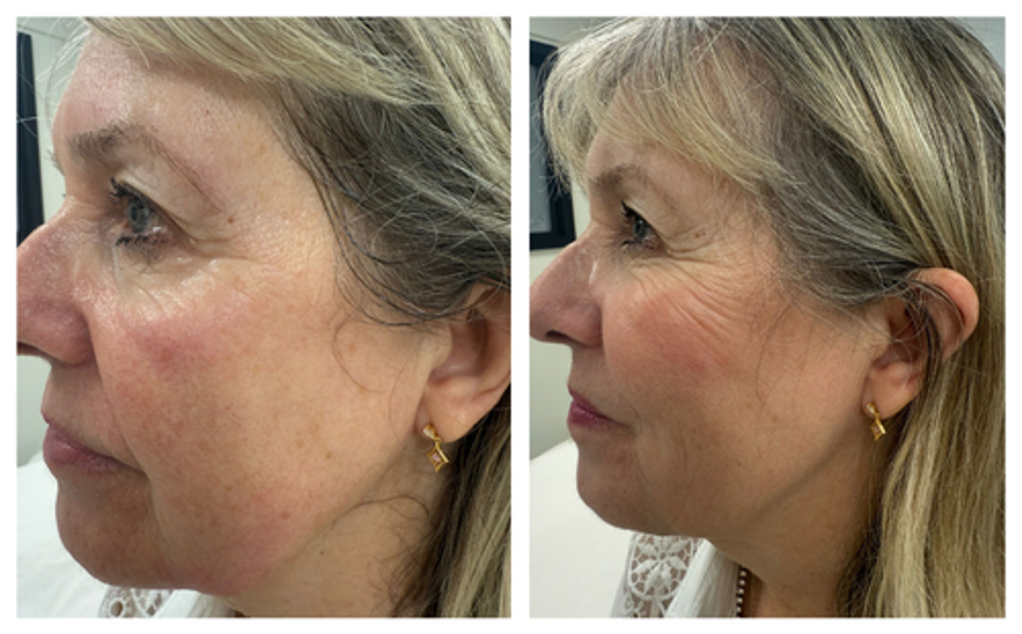 Professional HIFU skin tightening treatment at The De Peyer Clinic in Durley, Southampton, designed to lift and firm the skin naturally.