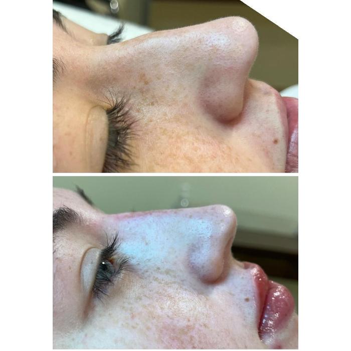 Professional non surgical nose filler treatment at The De Peyer Clinic in Durley, Southampton, enhancing profile balance without surgery.
