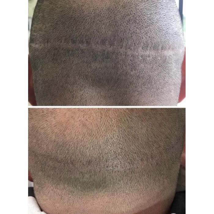 Professional scar medical tattooing at The De Peyer Clinic in Durley, Southampton, helping to visually blend and soften the appearance of scars.