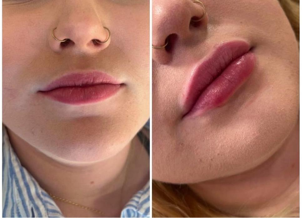Professional lip dermal filler treatment at The De Peyer Clinic in Durley, Southampton, enhancing volume while maintaining natural looking results.