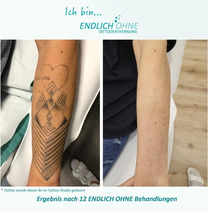 ENDLICH OHNE Tattooentfernung Filiale Aachen, Vaalser Straße in Aachen