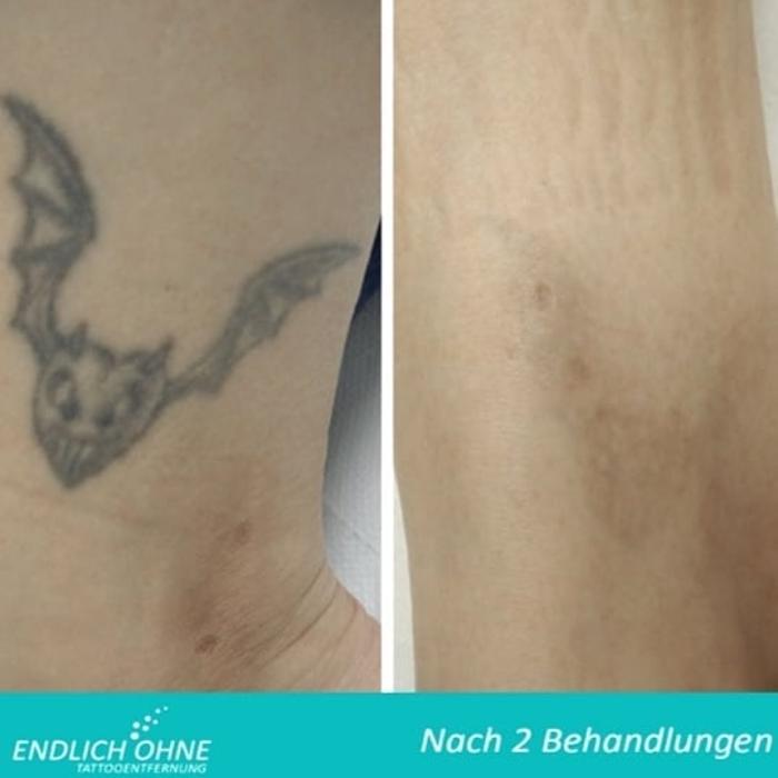ENDLICH OHNE Tattooentfernung Filiale Aachen, Vaalser Straße in Aachen