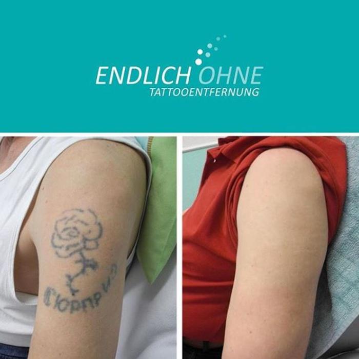 ENDLICH OHNE Tattooentfernung Filiale Aachen, Vaalser Straße in Aachen