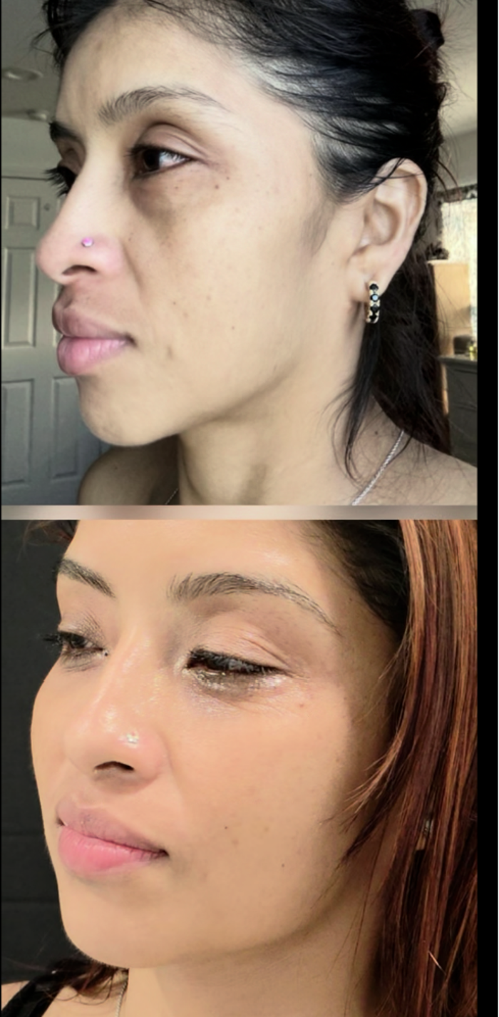 Figurarte Centro Estetico Radiesse Biostimulator Before and After Results, different angle, Brandon, FL 
&ldquo;facials Brandon FL&rdquo;, &ldquo;facials Tampa Bay&rdquo;, &ldquo;facials near me&rdquo;