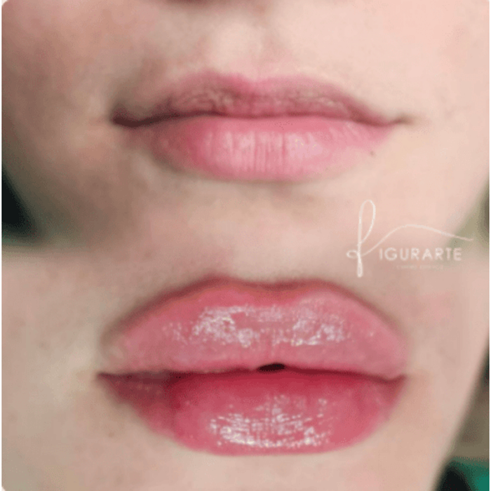 Figurarte Centro Estetico Lip Fillers, Before and After, Brandon FL
&ldquo;facials Brandon FL&rdquo;, &ldquo;facials Tampa Bay&rdquo;, &ldquo;facials near me&rdquo;