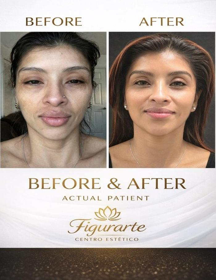 Figurarte Centro Estetico Radiesse Biostimulator Before and After Results, Brandon, FL
&ldquo;facials Brandon FL&rdquo;, &ldquo;facials Tampa Bay&rdquo;, &ldquo;facials near me&rdquo;