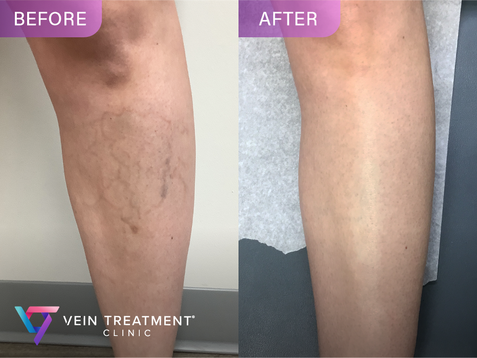 Vein Treatment Clinic | Upper East Side