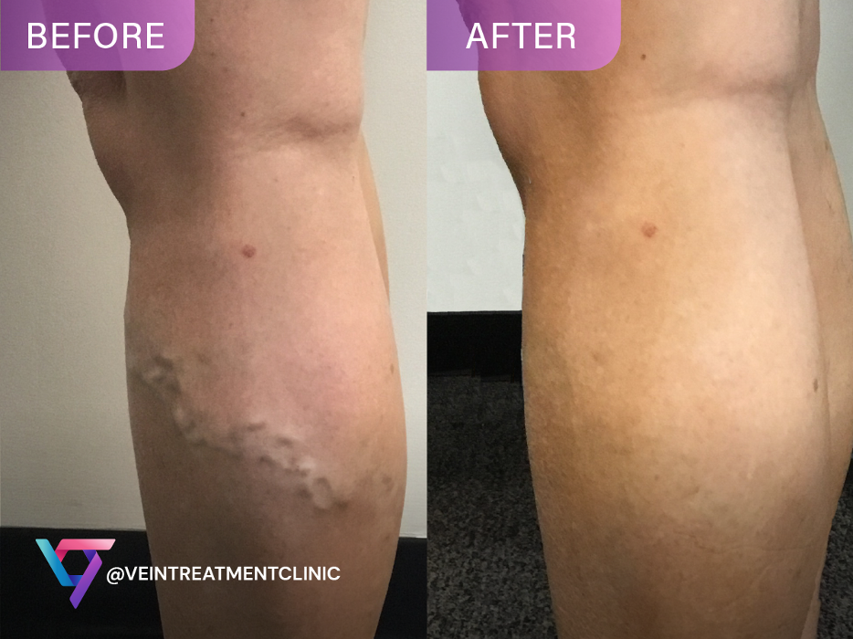 Vein Treatment Clinic | Port Jefferson, NY