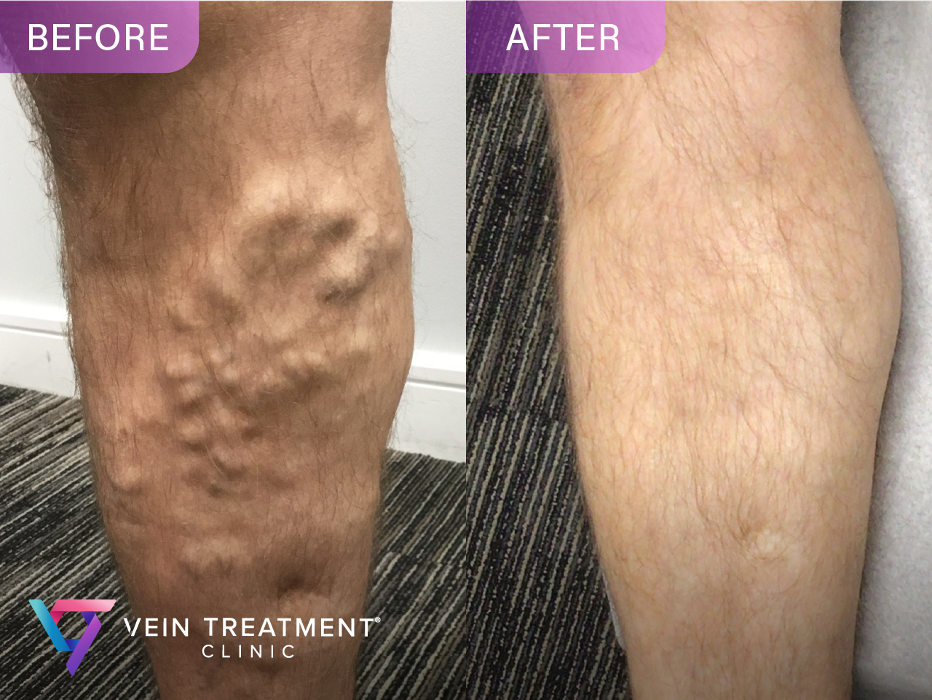 Vein Treatment Clinic | Hoboken