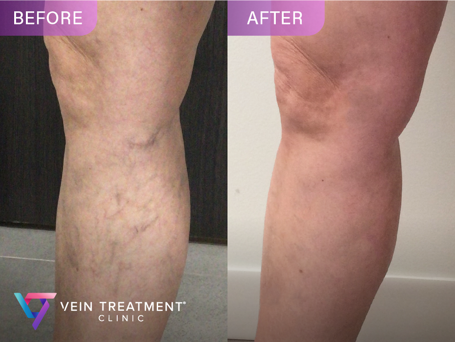 Vein Treatment Clinic | Harrison
