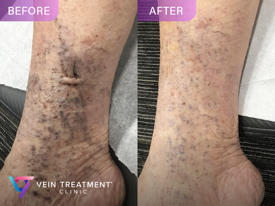 Vein Treatment Clinic | Rockville Centre