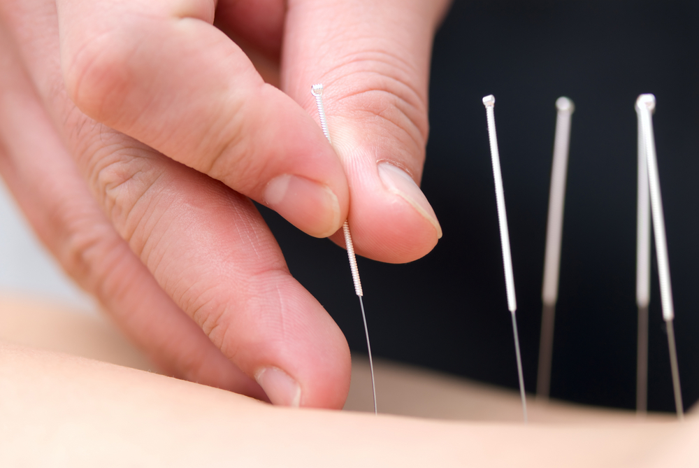 TJ Acupuncture Ilford 07515 695369