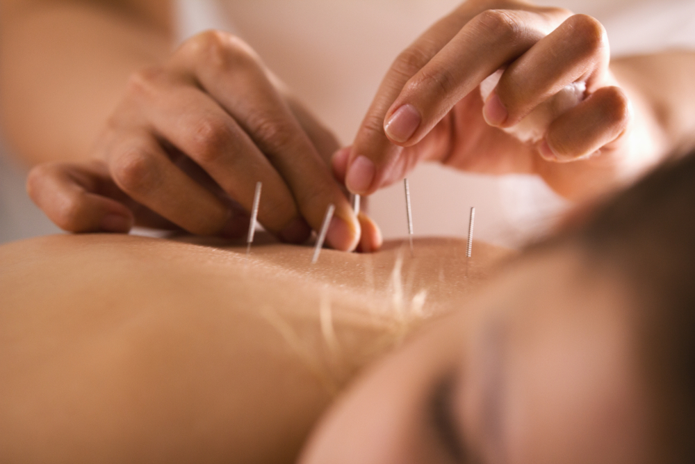 TJ Acupuncture Ilford 07515 695369