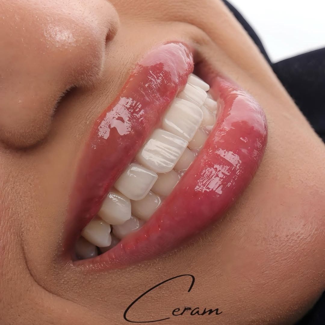 Veneers for 70BD! offer at Ceram Specialist Dental Center