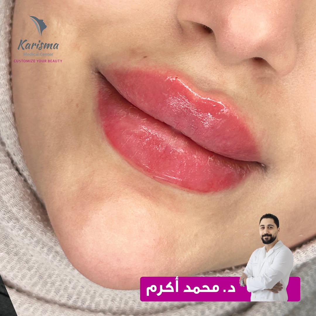 1ML Filler CROMA BD55! offer at Karisma Medical Center