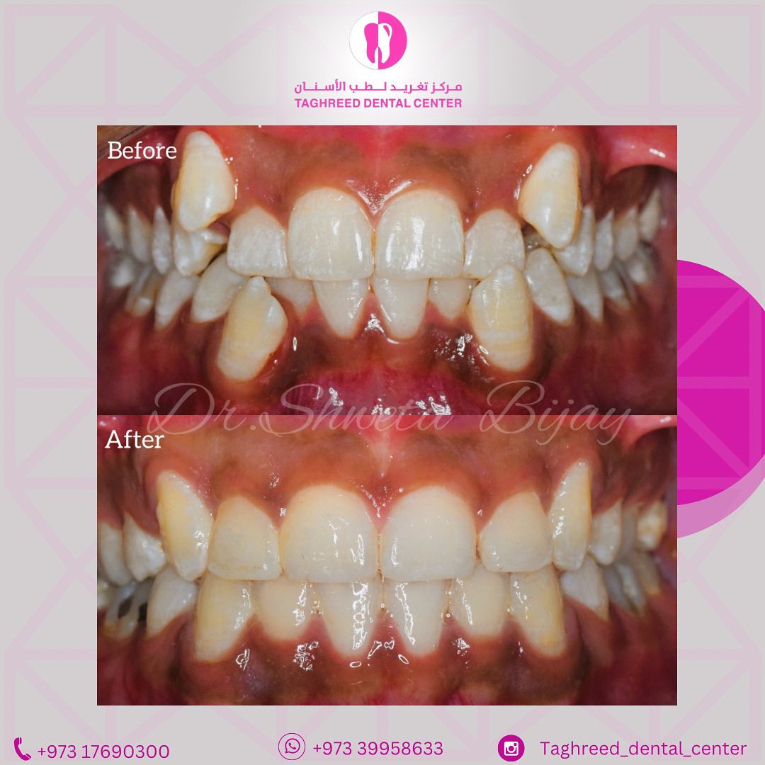25% OFF braces appointments offer at Taghreed Dental Center
