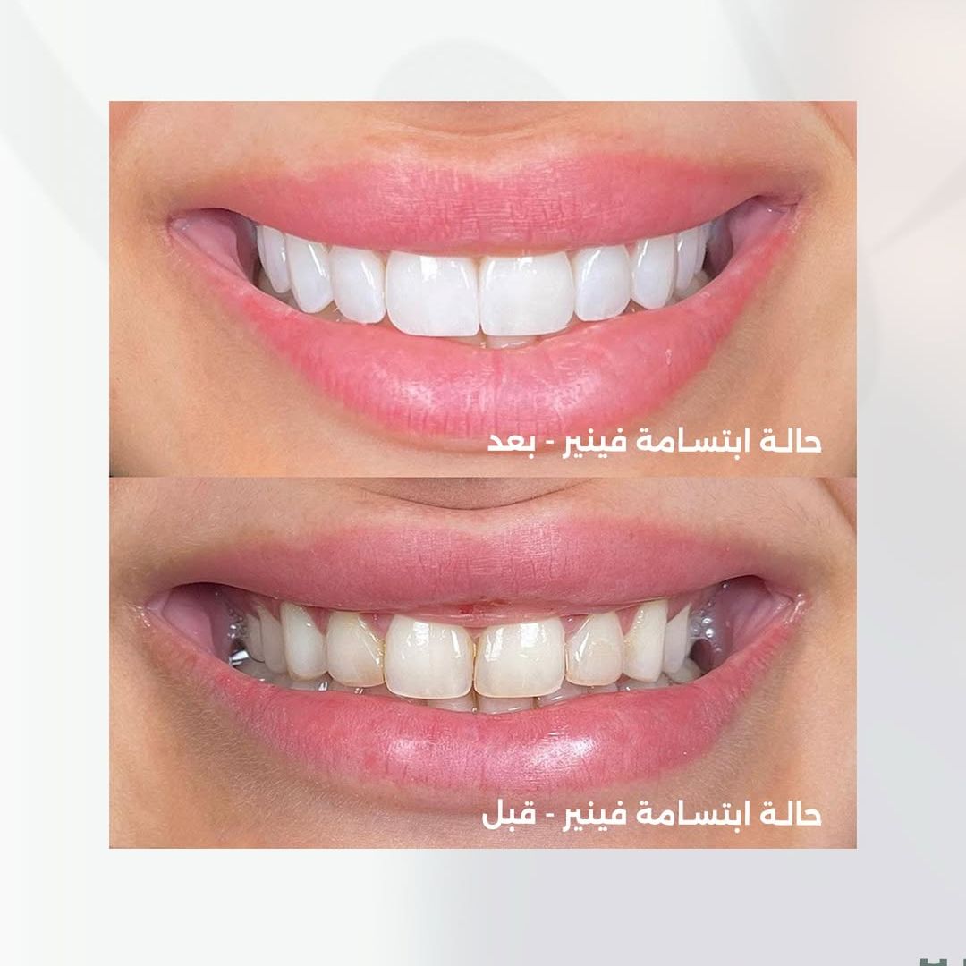 خصم ٥٠٪ offer at عيادة ألبا لطب الأسنان