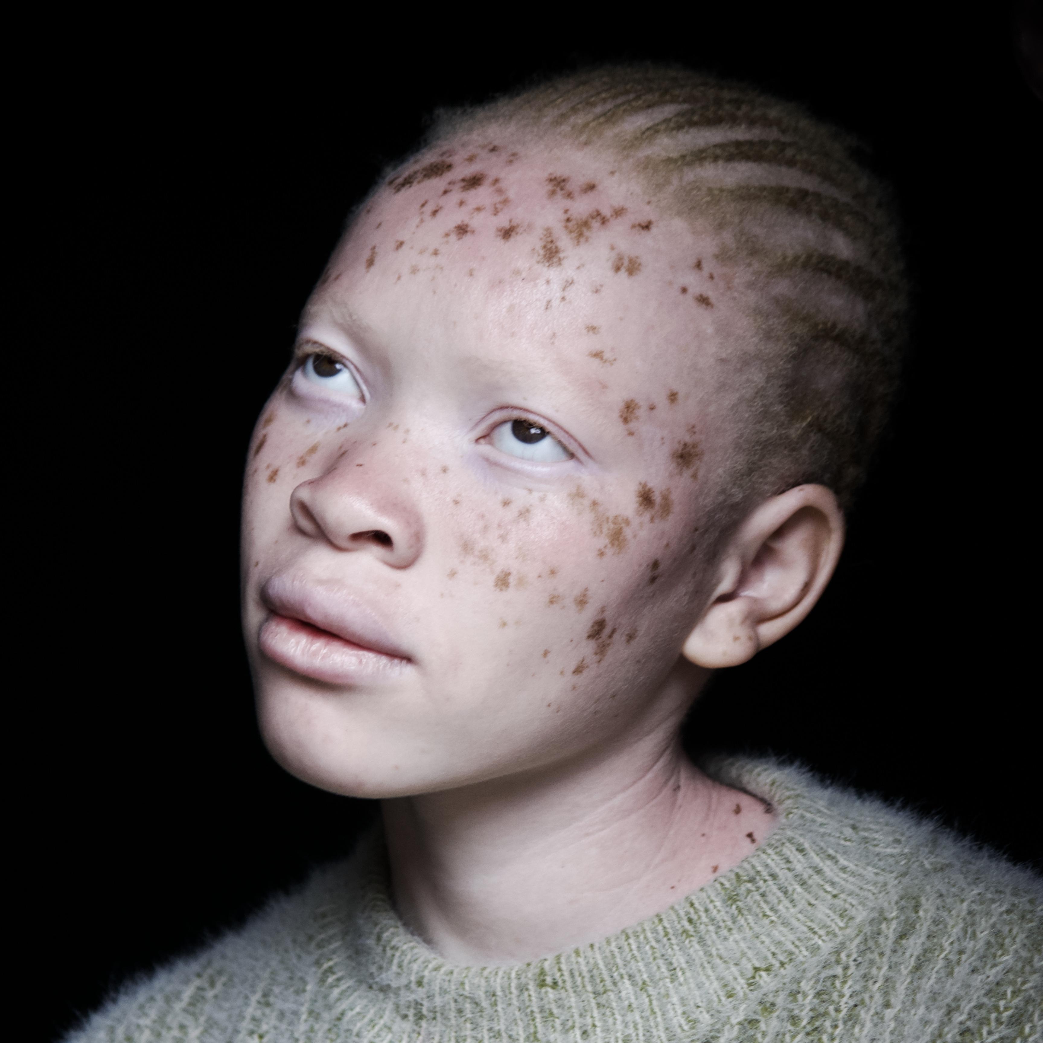 BORN DIFFERENT. Helping People with Albinism in Zambia