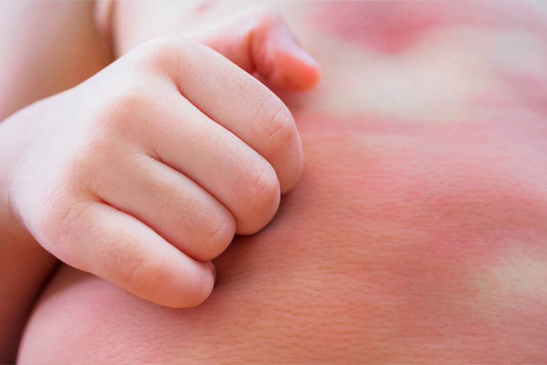 Kako prepoznati i leiti atopijski dermatitis kod dece?