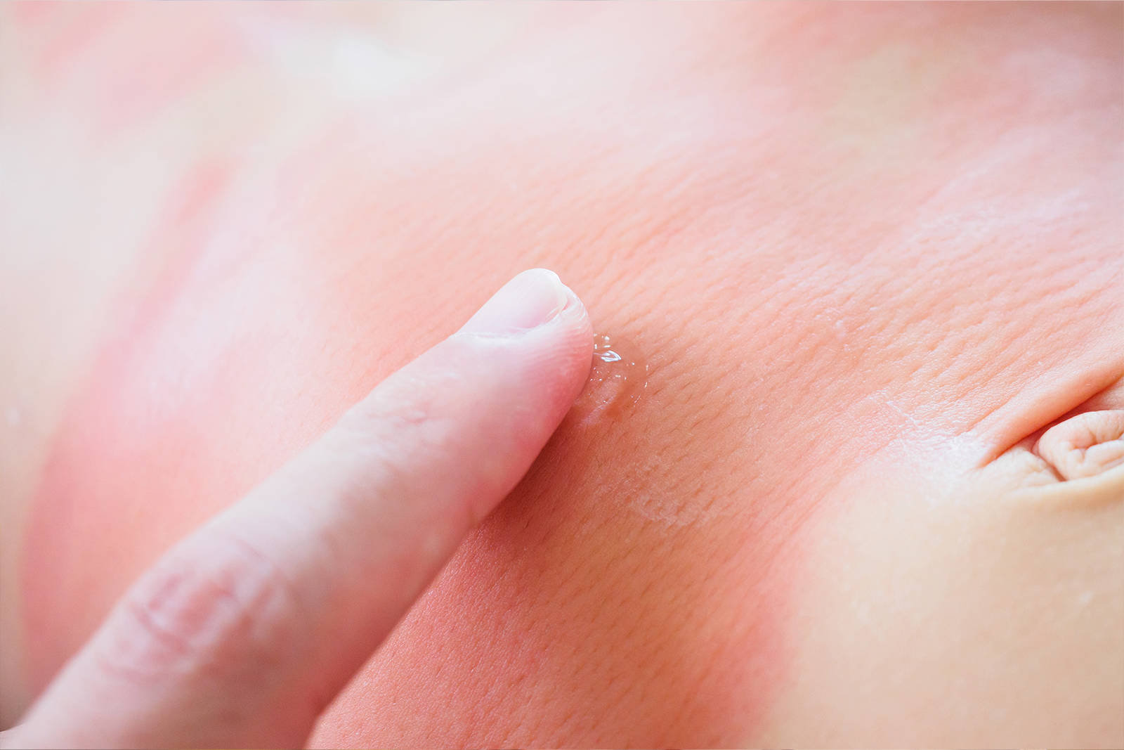 Atopijski dermatitis  simptomi i leenje - Doktok