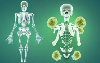 A cannabis leaf next to a skeleton depicting an arthritic joint