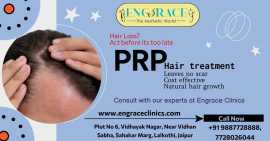 PRP Hair Loss Treatment at Engrace Clinics Jaipur, Jaipur