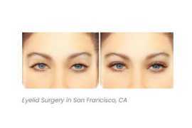 Eyelid Surgery San Francisco, San Francisco
