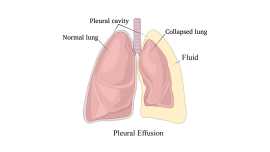 Pleural Effusion Treatment Cost in India, Delhi