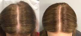 Hair Restoration in San Francisco, San Francisco