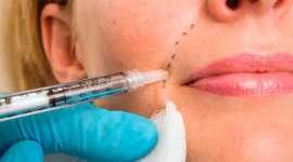 Get Fresh Faced with Fillers in Riverside, Riverside