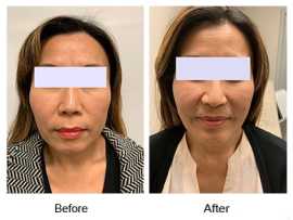 Cheek Implant in San Francisco, San Francisco