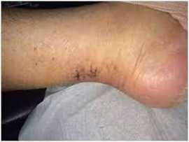 5 Facts About Achilles Tear Surgery , Novena